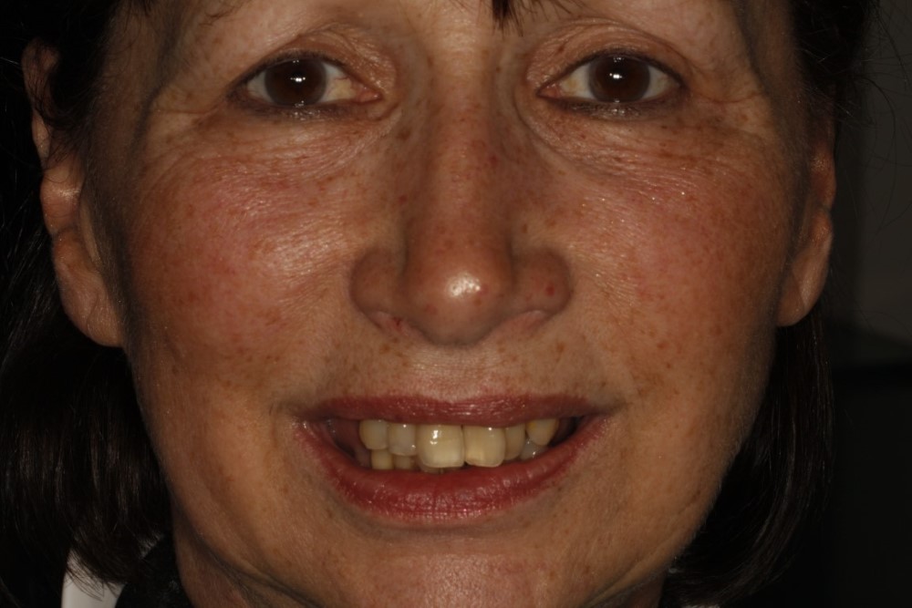 Janet All on Four Dental Implants Before