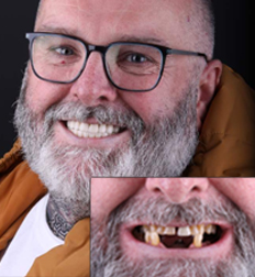 All On 4 / 6 Dental Implant Makeover