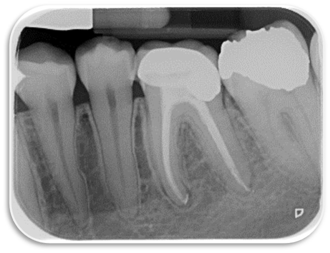 Root canal almost fully healed