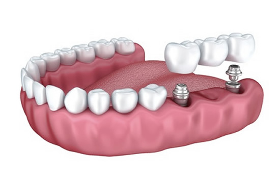 Dental Bridge