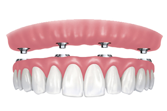 Implant Denture