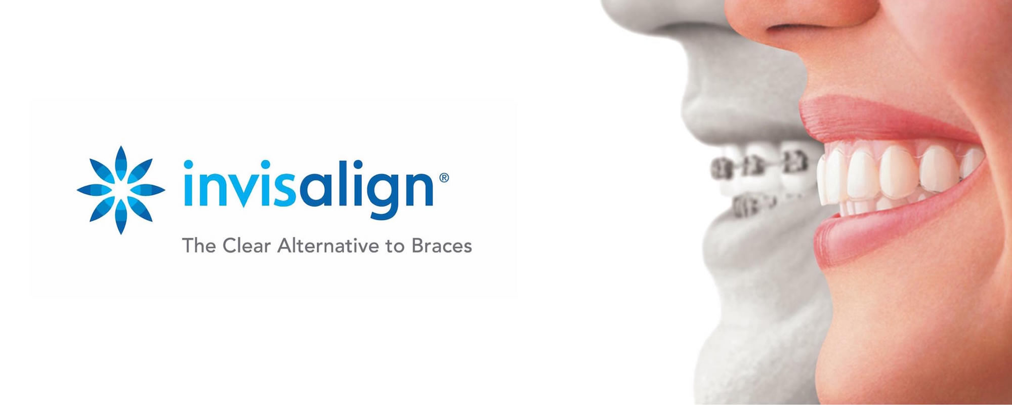 Invisalign Orthodontics Bexleyheath